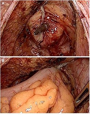 Quality of Life in Patients With Rectal Resections and End-to-End Primary Anastomosis Using a Standardized Perioperative Pathway